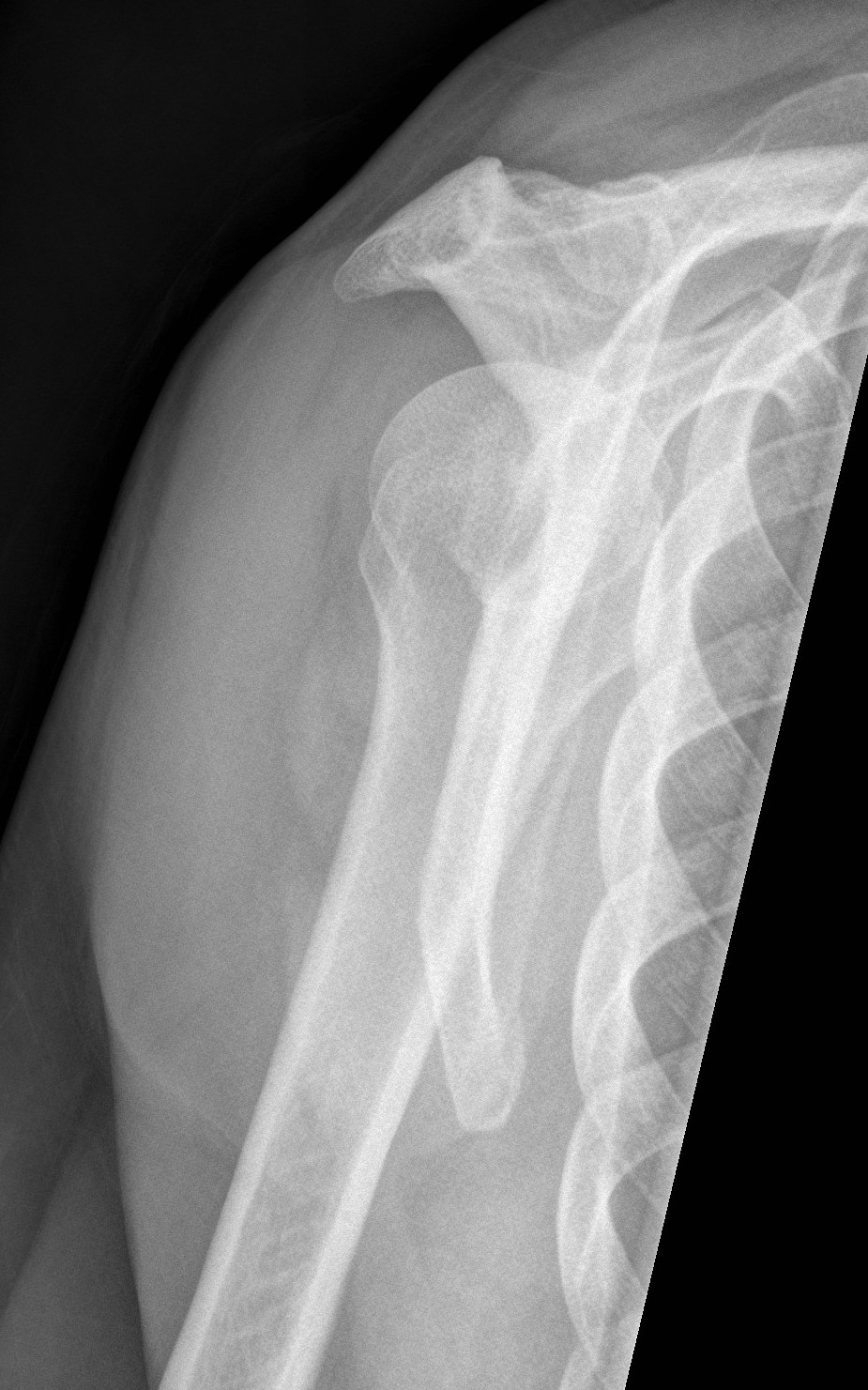 Shoulder Xrays | The Bone School
